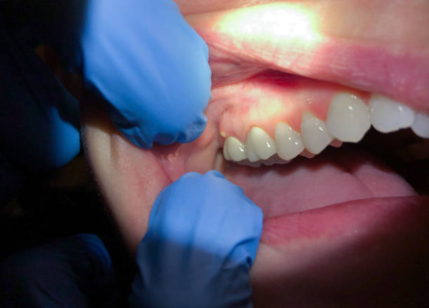 Best Broken or Cracked Tooth Emergency Dentist in North Druid Hills, GA